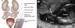 Prenatal vesicoamniotic shunt placement