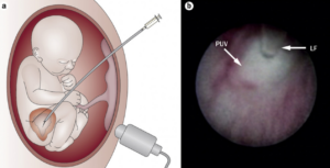 Visualization of the fetal bladder neck by fetal cystoscopy